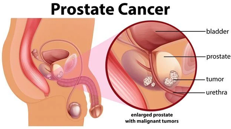 Kanker Prostat: Gejala dan Pencegahan dari PAFI Parigi